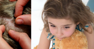 Rettenetes! A fejtetvek ölték meg a kislányt, szüleit letartóztatták