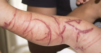 Iszonyú fájdalmas görcsök között halt meg egy 17 éves fiú, egy csípés okozott tragédiát